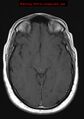 Neuroglial cyst (Radiopaedia 10713-11184 Axial T1 13).jpg