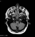 Neurosarcoidosis (Radiopaedia 10930-11351 Axial FLAIR 3).jpg