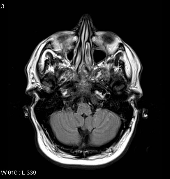 File:Neurosarcoidosis (Radiopaedia 10930-11351 Axial FLAIR 3).jpg