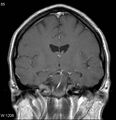 Neurosarcoidosis (Radiopaedia 10930-17204 Coronal T1 C+ 9).jpg