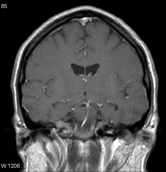 File:Neurosarcoidosis (Radiopaedia 10930-17204 Coronal T1 C+ 9).jpg