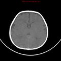 Non-accidental injury - bilateral subdural with acute blood (Radiopaedia 10236-10765 Axial non-contrast 12).jpg