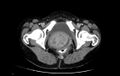 Non-puerperal uterine inversion (Radiopaedia 78343-91094 A 74).jpg