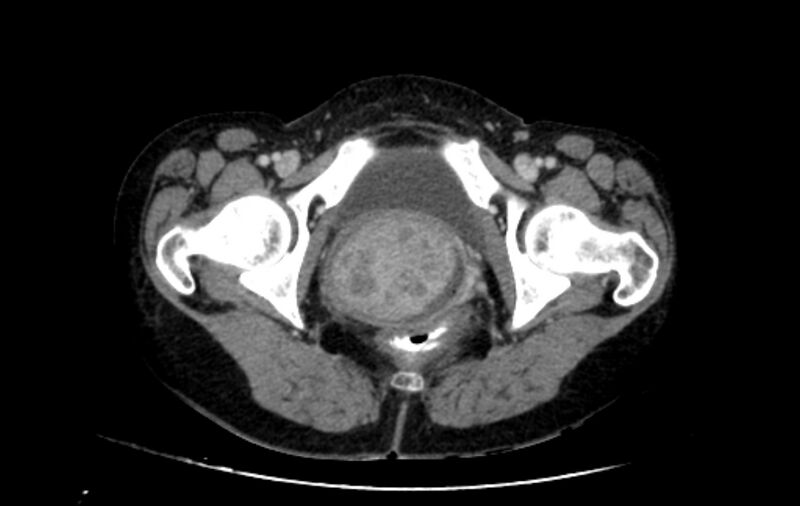 File:Non-puerperal uterine inversion (Radiopaedia 78343-91094 A 74).jpg