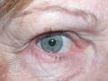 Nonspecific blepharitis (DermNet NZ site-age-specific-blepharitis2).jpg
