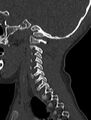 Normal CT cervical spine - pediatric (Radiopaedia 52549-58462 Sagittal bone window 43).jpg