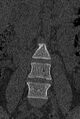 Normal CT lumbar spine (Radiopaedia 53981-60118 Coronal bone window 10).jpg