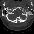 Normal CT of the cervical spine (Radiopaedia 53322-59305 Axial bone window 37).jpg