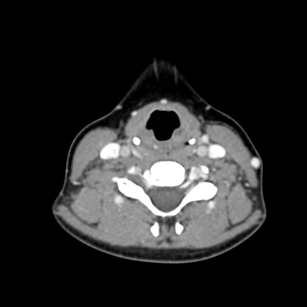 File:Normal CT of the neck (Radiopaedia 14575-14500 Axial C+ 44).jpg