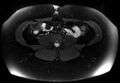 Normal liver MRI with Gadolinium (Radiopaedia 58913-66163 Axial T2 fat sat 2).jpg