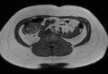 Normal liver MRI with Gadolinium (Radiopaedia 58913-66163 B 5).jpg
