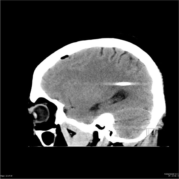 File:Normal pressure hydrocephalus (Radiopaedia 24415-24736 A 22).jpg