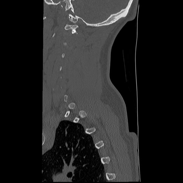 File:Normal trauma spine imaging (Radiopaedia 31753-32686 Sagittal bone window 5).jpg