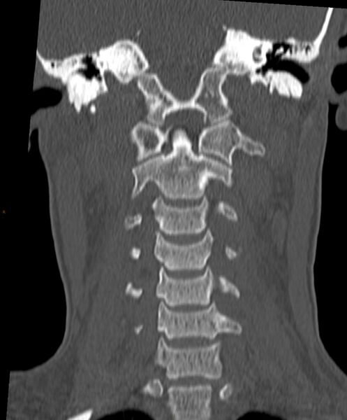File:Occipital condyle fracture (Radiopaedia 61165-69056 Coronal bone window 10).jpg