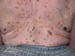 Seborrhoeic keratosis (DermNet NZ lesions-bcp1).jpg