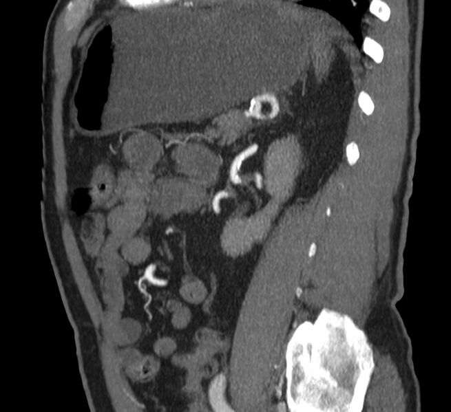 File:Abdominal aortic aneurysm (Radiopaedia 22421-22458 D 31).jpg