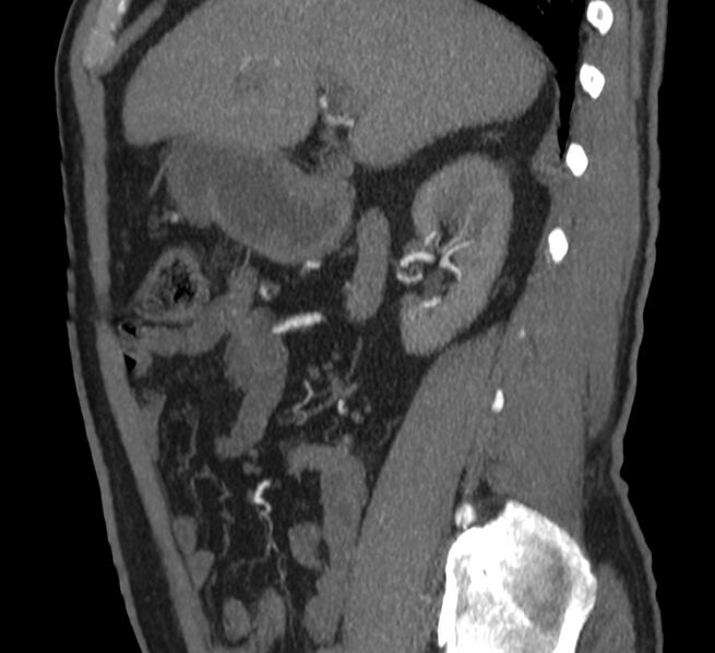 File:Abdominal aortic aneurysm (Radiopaedia 22421-22458 D 9).jpg