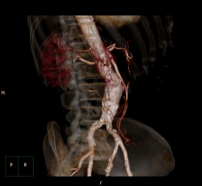 File:Abdominal aortic aneurysm (Radiopaedia 23703-23856 3D 10).jpg