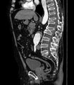 Abdominal aortic aneurysm (Radiopaedia 25855-26001 Sagittal C+ arterial phase 23).jpg