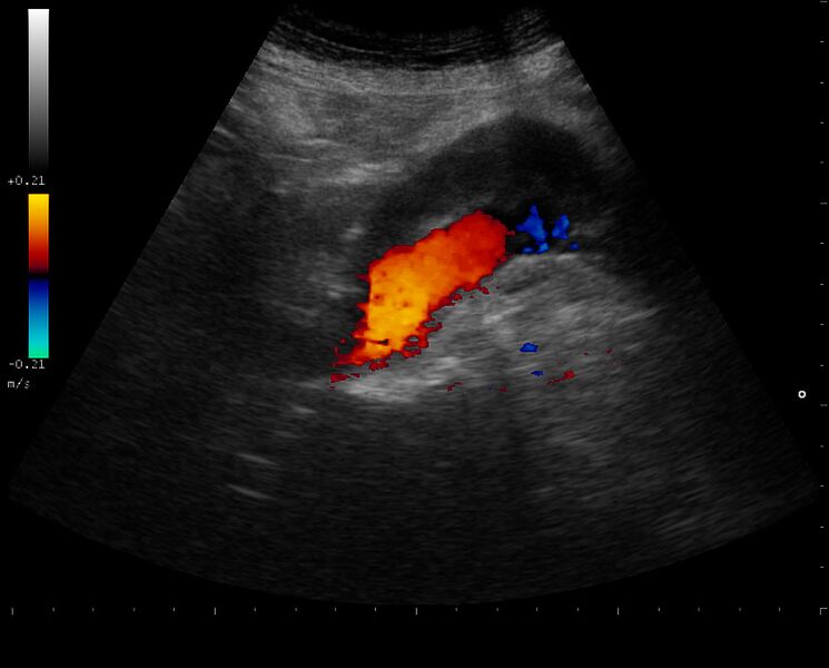 File:Abdominal aortic aneurysm (Radiopaedia 34563-35938 B 1).jpg