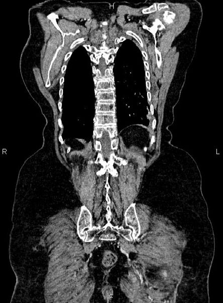 File:Abdominal aortic aneurysm (Radiopaedia 85063-100606 Coronal C+ arterial phase 51).jpg