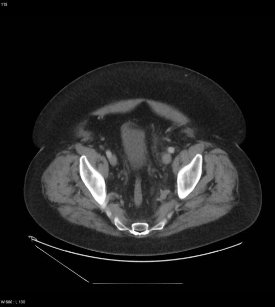 File:Abdominal aortic aneurysm with intramural hematoma then rupture (Radiopaedia 50278-55631 Axial C+ arterial phase 110).jpg