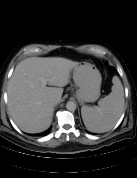 File:Abdominal lymphoma - with sandwich sign (Radiopaedia 53486-59492 Axial C+ portal venous phase 9).jpg