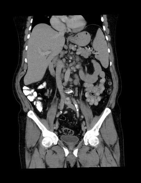 File:Abdominal lymphoma - with sandwich sign (Radiopaedia 53486-59492 C+ portal venous phase 29).jpg