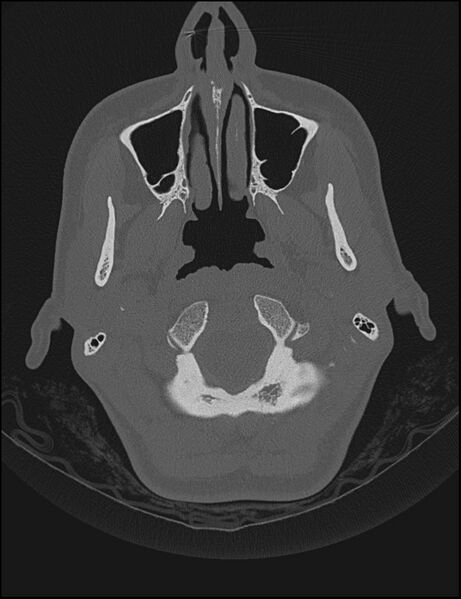 File:Aberrant right internal carotid artery (Radiopaedia 65191-74198 Axial non-contrast 7).jpg