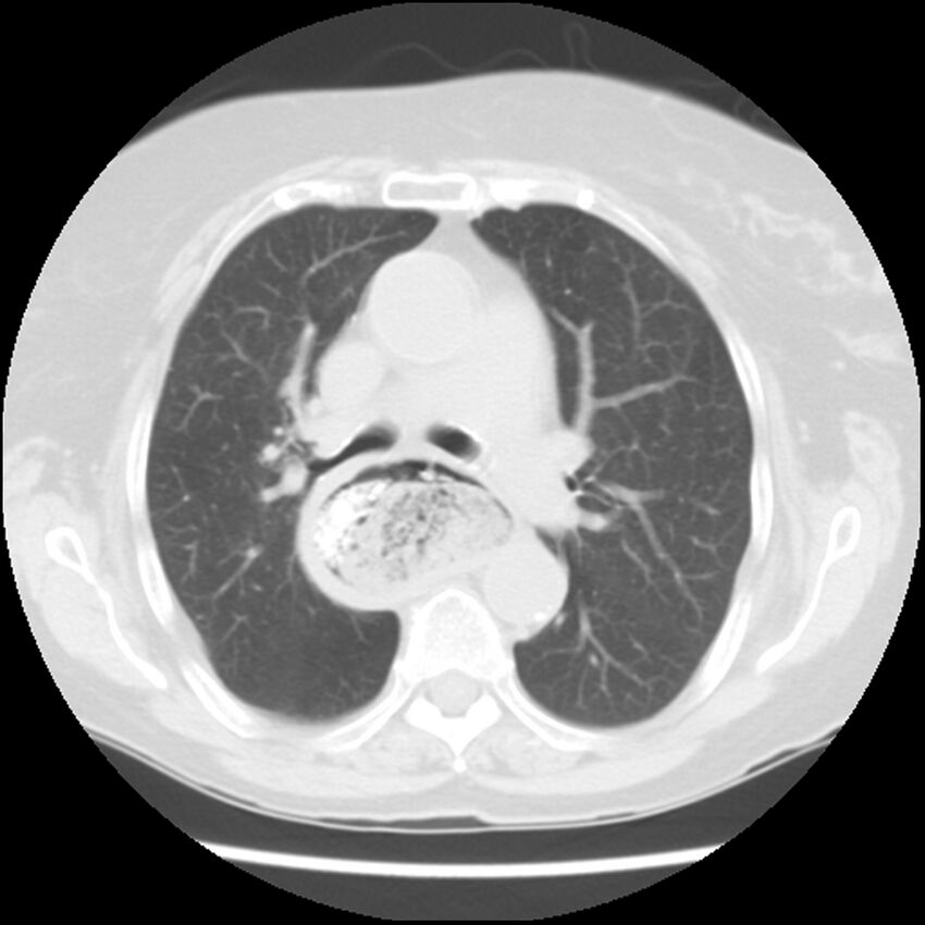 Achalasia (Radiopaedia 44094-47649 Axial lung window 24).jpg