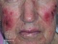 Actinic Keratoses treated with imiquimod (DermNet NZ lesions-ak-imiquimod-3757).jpg