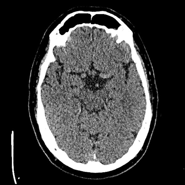 File:Acute A3 occlusion with ACA ischemic penumbra (CT perfusion) (Radiopaedia 72036-82525 Axial non-contrast thins 6).jpg