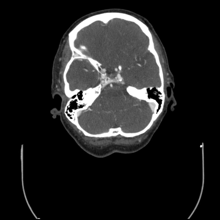 Acute M1 occlusion with ischemic penumbra (CT perfusion) (Radiopaedia 71897-82344 Axial C+ arterial phase thins 109).jpg