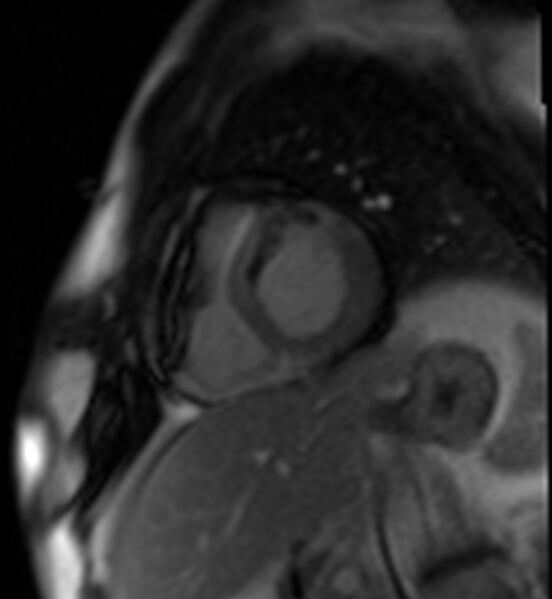 File:Acute anteroseptal myocardial infarction (Radiopaedia 68409-77945 Short axis (basal) Perfusion 47).jpg