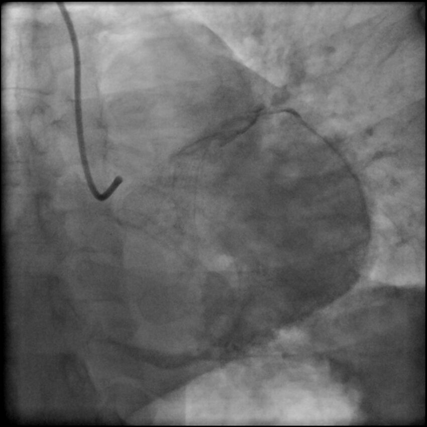 Acute anteroseptal myocardial infarction (Radiopaedia 68409-77946 LAO caudal (spider view) LAD and CX 78).jpg