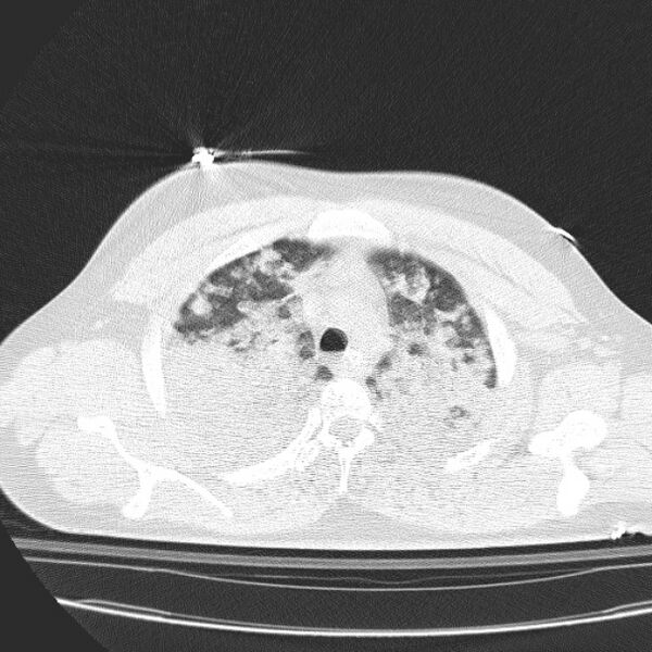 File:Acute aspiration pneumonitis (Radiopaedia 33605-34703 Axial lung window 28).jpg
