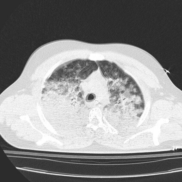 File:Acute aspiration pneumonitis (Radiopaedia 33605-34703 Axial lung window 32).jpg