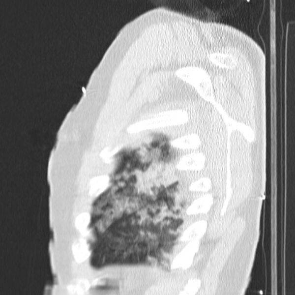 File:Acute aspiration pneumonitis (Radiopaedia 33605-34703 Sagittal lung window 77).jpg