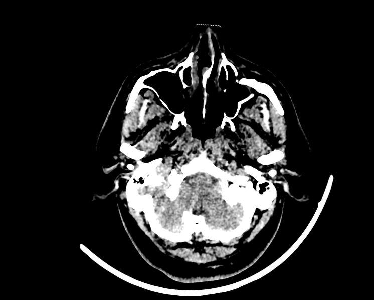 File:Acute cerebral infarct (Radiopaedia 35604-37123 Axial non-contrast 10).jpg