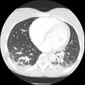 Acute chest syndrome - sickle cell disease (Radiopaedia 42375-45499 Axial lung window 123).jpg