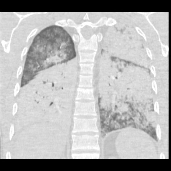 File:Acute diffuse alveolar hemorrhage (Radiopaedia 41323-44158 Coronal lung window 41).jpg