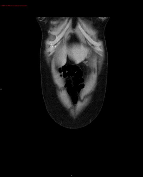 File:Acute gastritis (Radiopaedia 21043-20975 Coronal C+ portal venous phase 28).jpg