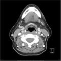 Acute left parotid sialadenitis (Radiopaedia 26160-26295 C+ arterial phase 31).jpg