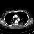 Acute myocardial infarction in CT (Radiopaedia 39947-42415 Axial C+ arterial phase 45).jpg