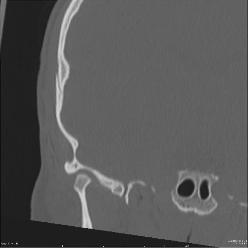 Acute otomastoiditis (Radiopaedia 28276-28512 Coronal PTB bone window reformat 4).jpg