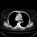 Acute pancreatitis - Balthazar C (Radiopaedia 26569-26714 Axial C+ portal venous phase 3).jpg