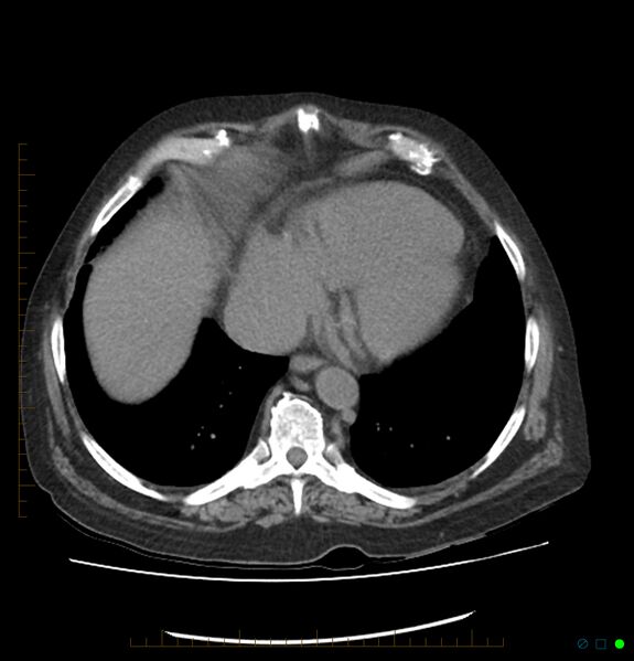 File:Acute renal failure post IV contrast injection- CT findings (Radiopaedia 47815-52557 Axial non-contrast 8).jpg