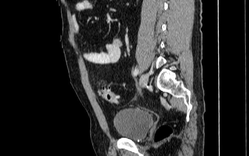 Acute sigmoid colon diverticulitis (Radiopaedia 55507-61976 Sagittal C+ portal venous phase 34).jpg