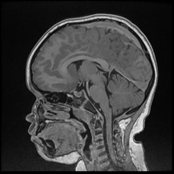 File:Adamantinomatous craniopharyngioma (Radiopaedia 77407-89529 Sagittal T1 C+ 71).jpg