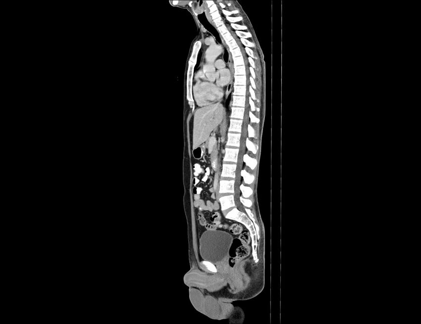 Addison disease (Radiopaedia 49318-54412 Sagittal C+ portal venous phase 35).jpg